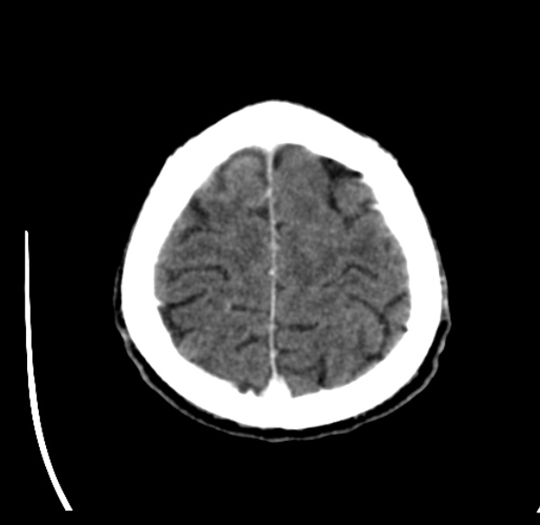 File:Brain metastases from lung cancer (Radiopaedia 24480-24781 Axial C+ delayed 54).jpg