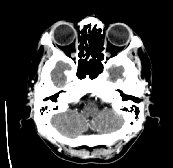 File:Brain metastases from lung cancer (Radiopaedia 24480-24781 Axial C+ delayed 7).jpg