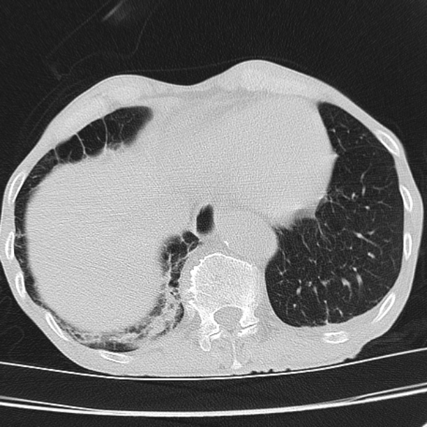 Brain metastases from lung cancer (Radiopaedia 27849-28093 Axial lung window 54).jpg
