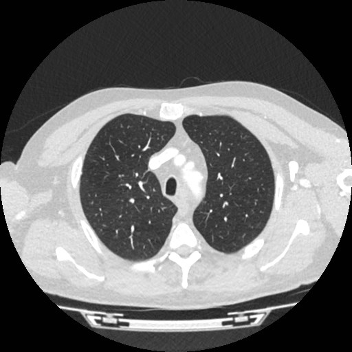 File:Brain metastases from lung cancer (Radiopaedia 83839-99030 Axial lung window 8).jpg