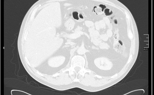 Brain metastases from squamocellular lung cancer (Radiopaedia 56515-63219 Axial lung window 66).jpg