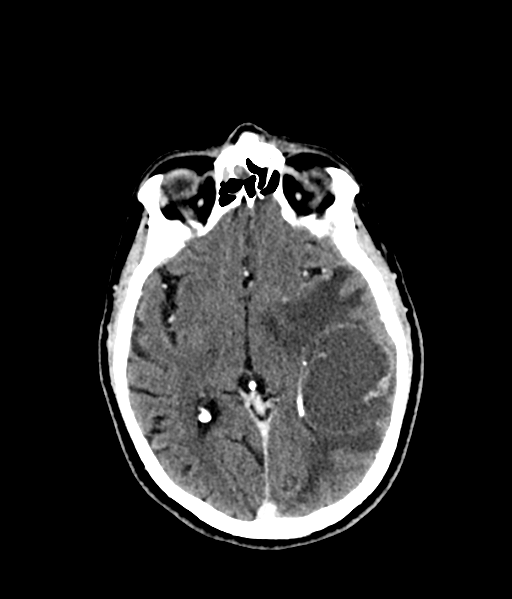 Brain metastasis (large cystic mass) (Radiopaedia 47497-52106 Axial C+ 31).png