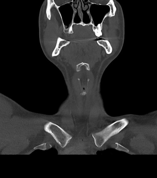 Branchial cleft cyst (Radiopaedia 31167-31875 Coronal bone window 22).jpg