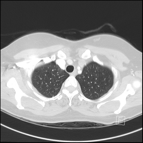 File:Breast metastases from renal cell cancer (Radiopaedia 79220-92225 Axial lung window 13).jpg