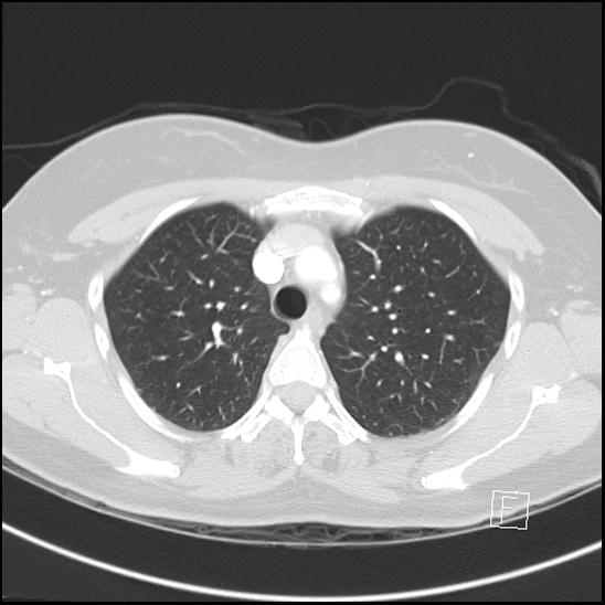 File:Breast metastases from renal cell cancer (Radiopaedia 79220-92225 Axial lung window 21).jpg