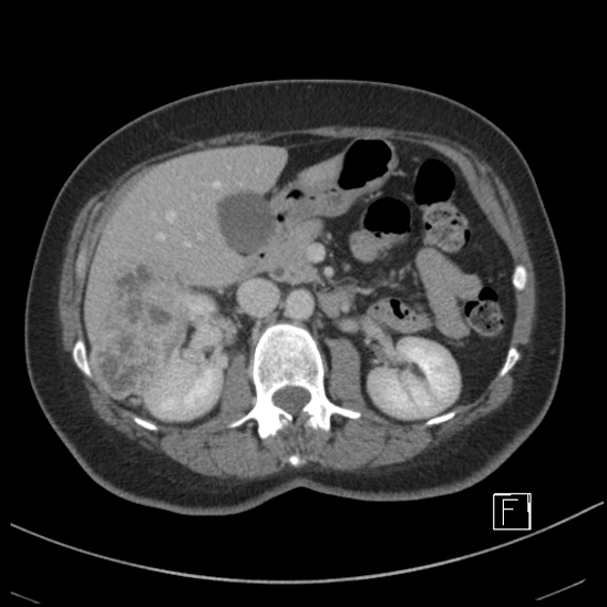 File:Breast metastases from renal cell cancer (Radiopaedia 79220-92225 C 37).jpg