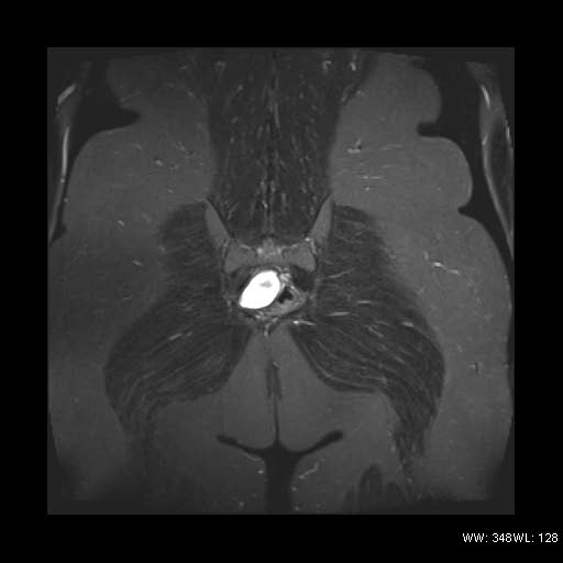 File:Broad ligament fibroid (Radiopaedia 49135-54241 Coronal STIR 24).jpg