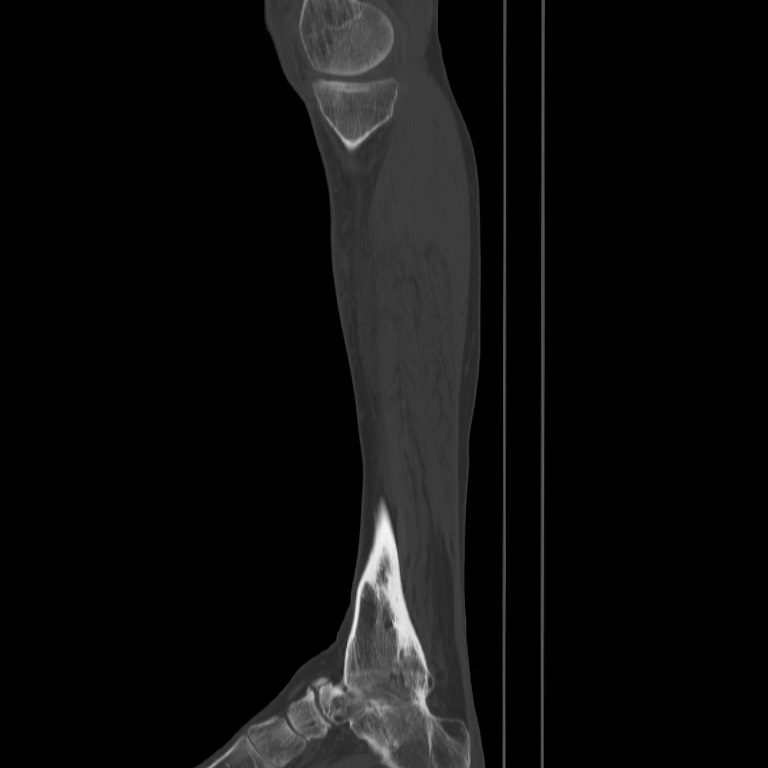 Brodie abscess - tibia (Radiopaedia 66028-75204 Sagittal bone window 10).jpg