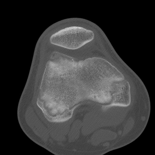 Brodie abscess of the tibia (Radiopaedia 58984-66250 Axial bone window 33).jpg