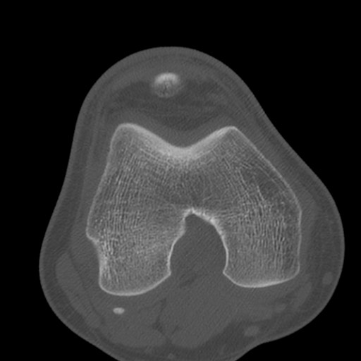 Brodie abscess of the tibia (Radiopaedia 58984-66250 Axial bone window 42).jpg