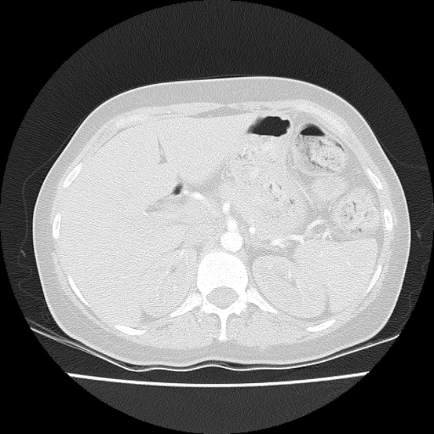 Bronchial atresia (Radiopaedia 22965-22992 Axial lung window 1).jpg