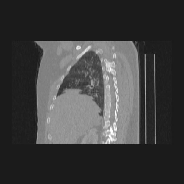 Bronchial atresia (Radiopaedia 60685-68439 Sagittal lung window 26).jpg