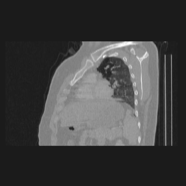 Bronchial atresia (Radiopaedia 60685-68439 Sagittal lung window 65).jpg
