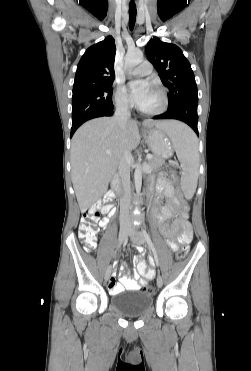Bronchial carcinoid tumor (Radiopaedia 57187-64090 B 37).jpg