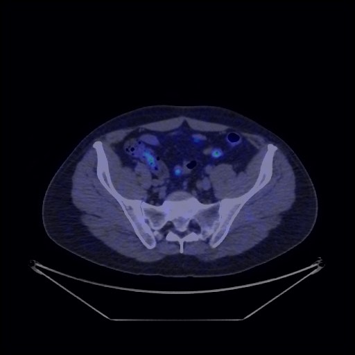 Bronchial carcinoid tumor (Radiopaedia 67377-76765 68Ga-DOTATATE PET-CT 65).jpg