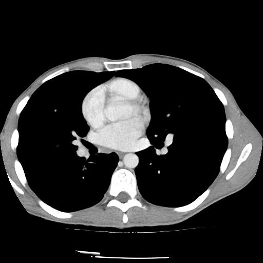 Bronchial carcinoid tumor causing right lower lobe collapse (Radiopaedia 83495-98594 A 28).jpg