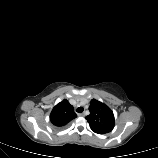 Bronchial mucoepidermoid carcinoma (Radiopaedia 57023-63895 Axial 25).jpg