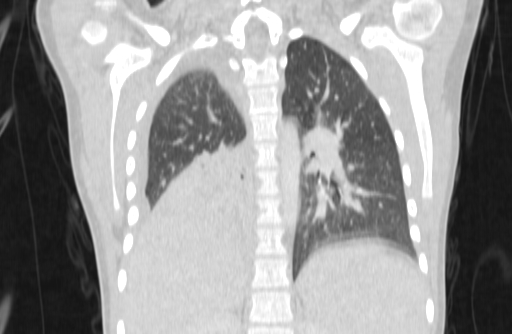 Bronchial mucoepidermoid carcinoma (Radiopaedia 57023-63895 Coronal lung window 52).jpg