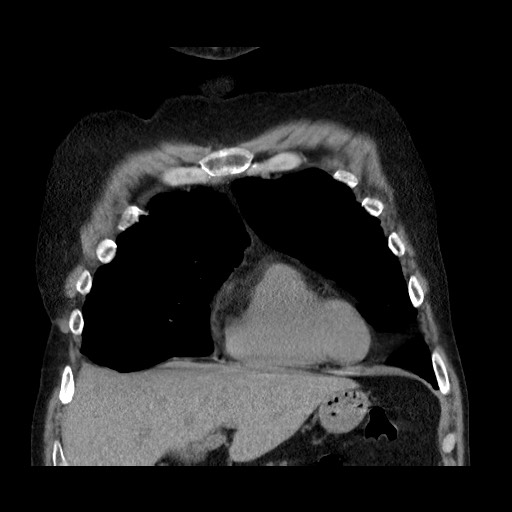 File:Bronchial stenosis - lung transplant (Radiopaedia 73133-83848 Coronal non-contrast 21).jpg