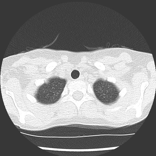 Bronchiolotis obliterans (Radiopaedia 73769-84575 Axial lung window 5).jpg