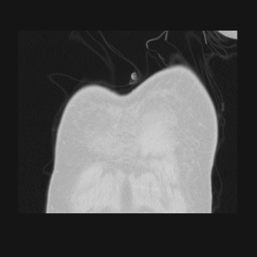 File:Bronchogenic carcinoma with metastatic lymphadenopathy (Radiopaedia 37671-39569 Coronal lung window 2).jpg