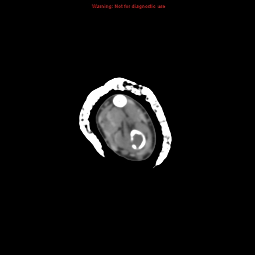 Brown tumor (Radiopaedia 12460-12694 Axial non-contrast 43).jpg