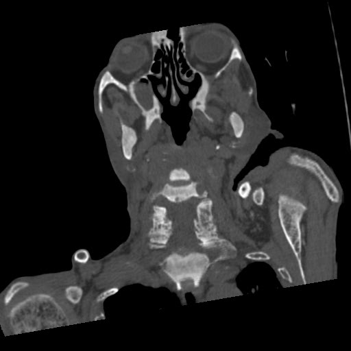 File:Brown tumor with secondary hyperparathyroidism (Radiopaedia 23591-23705 C 34).jpg
