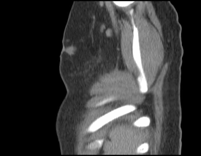 Brown tumors compressing the spinal cord (Radiopaedia 68442-77988 B 55).jpg