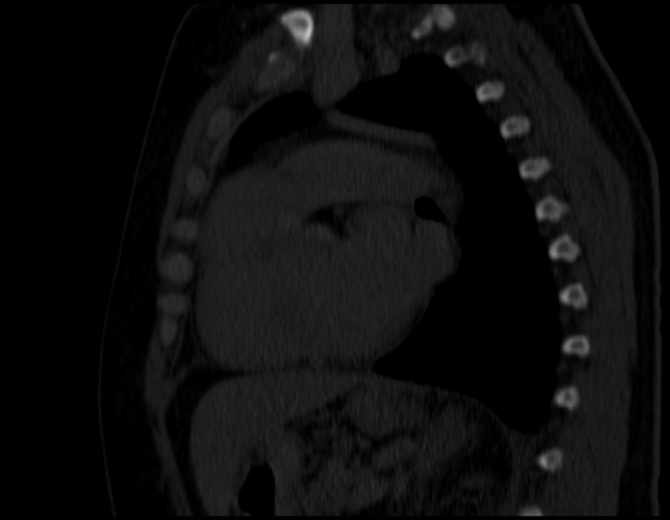 Brown tumors compressing the spinal cord (Radiopaedia 68442-77988 Sagittal bone window 35).jpg