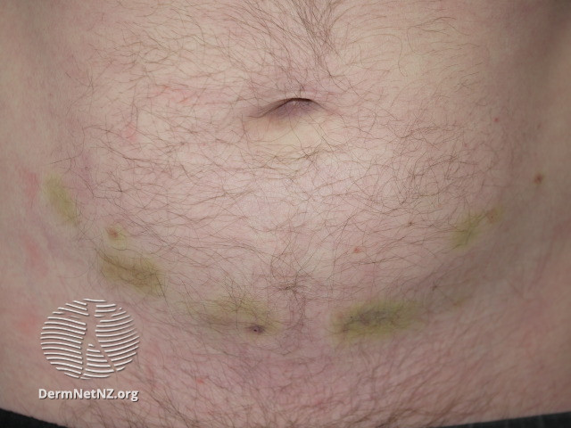 File:Bruising at the site of heparin injections (DermNet NZ bruising-05).jpg
