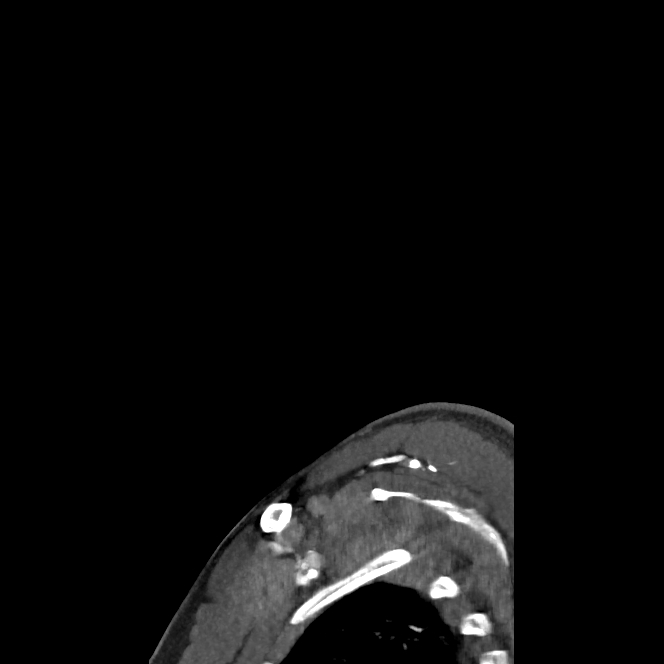 Buccal fat pad arteriovenous malformation (Radiopaedia 70936-81144 C 78).jpg