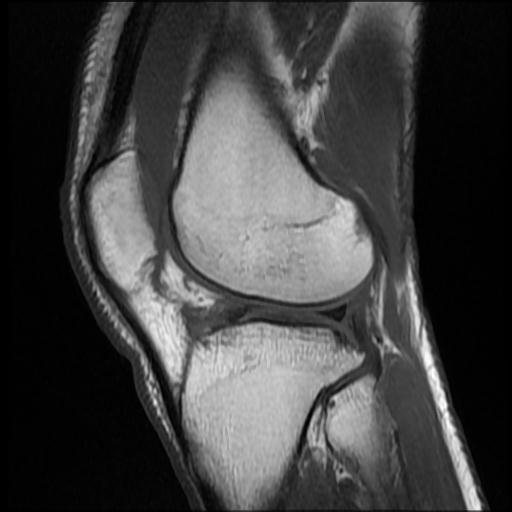 File:Bucket handle tear - medial meniscus (Radiopaedia 69245-79026 Sagittal T1 5).jpg