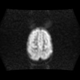 File:Burkitt lymphoma of the orbit- pre and post chemotherapy (Radiopaedia 31214-31929 Axial DWI 14).jpg