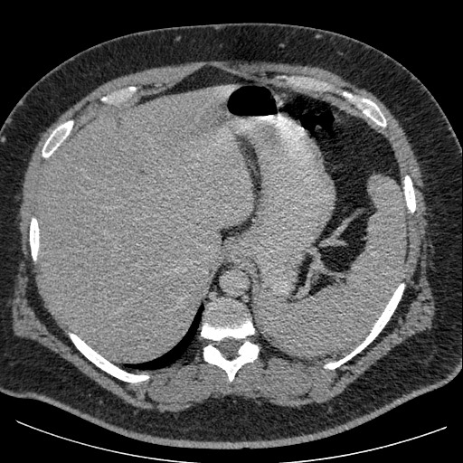 Burned-out testicular seminoma - retroperitoneal nodal metastases (Radiopaedia 62872-71245 A 14).jpg