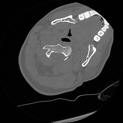 C1-C2 "subluxation" - normal cervical anatomy at maximum head rotation (Radiopaedia 42483-45607 Axial non-contrast 40).jpg