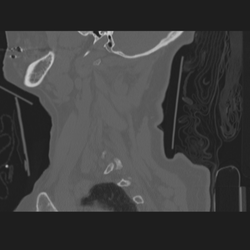 C2 fracture (Radiopaedia 34091-35341 Sagittal bone window 14).png