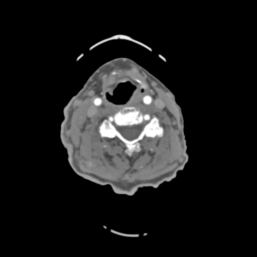 File:C2 fracture with vertebral artery dissection (Radiopaedia 37378-39200 A 125).png