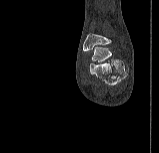 Calcaneal fracture - Sanders type 4 (Radiopaedia 90179-107370 Coronal bone window 74).jpg