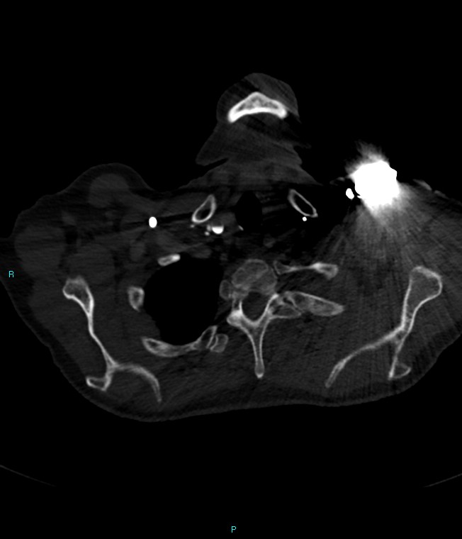 Calcified cerebral emboli from left ventricular thrombus (Radiopaedia 84420-99760 Axial bone window 6).jpg
