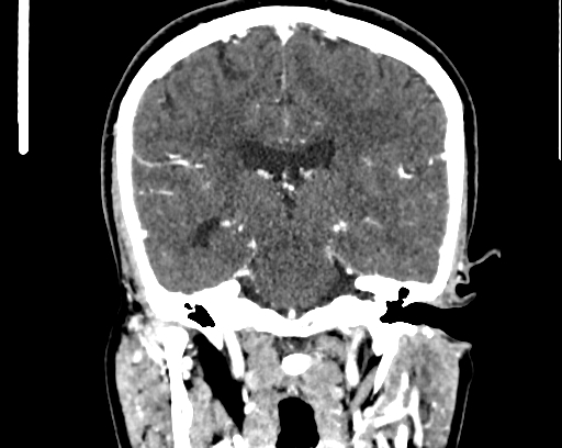 File:Calcified cerebral hydatid cyst (Radiopaedia 65603-74717 C 41).jpg