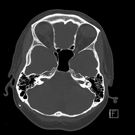 Calcified chronic subdural hematoma (Radiopaedia 77374-89492 Axial bone window 31).jpg