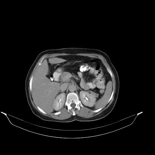 File:Calcified hydatid cyst of the liver (Radiopaedia 21212-21112 Axial C+ delayed 18).jpg