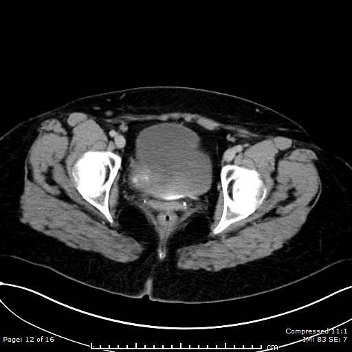 File:Calcified uterine fibroid (Radiopaedia 56077-62759 Axial C+ delayed 12).jpg