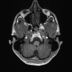 Callosal dysgenesis with interhemispheric cyst (Radiopaedia 53355-59335 Axial T1 24).jpg