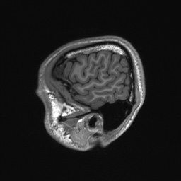 Callosal dysgenesis with interhemispheric cyst (Radiopaedia 53355-59335 Sagittal T1 155).jpg