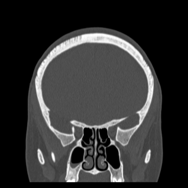Calvarial osteoma (Radiopaedia 36520-38079 C 30).jpg