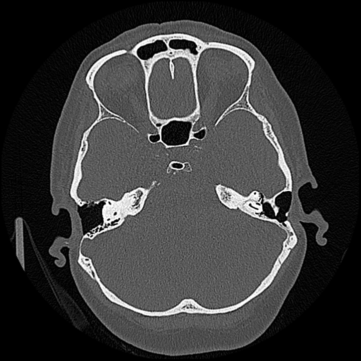 Canal up mastoidectomy (Radiopaedia 78108-90638 Axial bone window 94).jpg