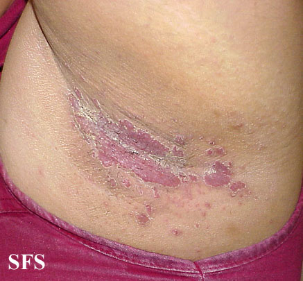 File:Candidiasis (Dermatology Atlas 18).jpg