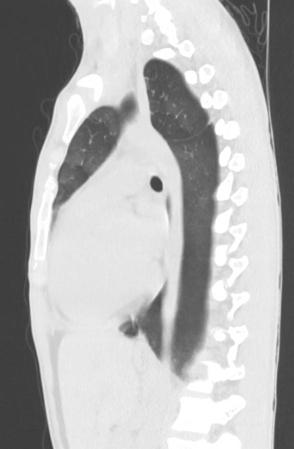 Cannabis-induced diffuse alveolar hemorrhage (Radiopaedia 89834-106946 Sagittal lung window 78).jpg