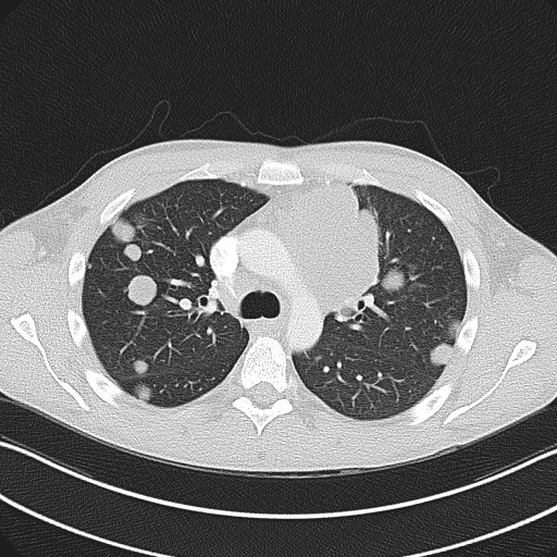 Cannonball metastases - testicular choriocarcinoma (Radiopaedia 84510-99891 Axial lung window 37).jpg